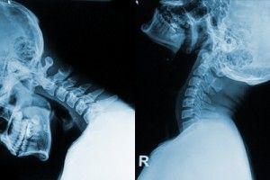 indemnización por esguince cervical indemnización por esguince cervical